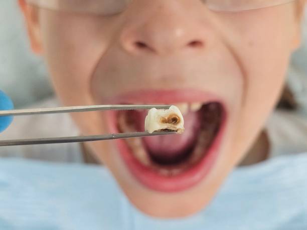 Best Emergency Dental Care for Broken or Chipped Teeth in Katy, TX